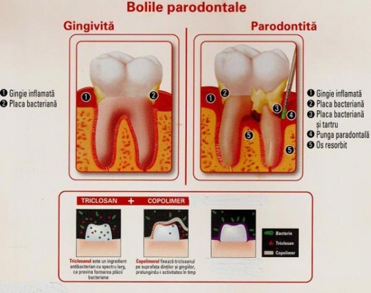 boala-parodontala-migali-dental-clinic-iasi