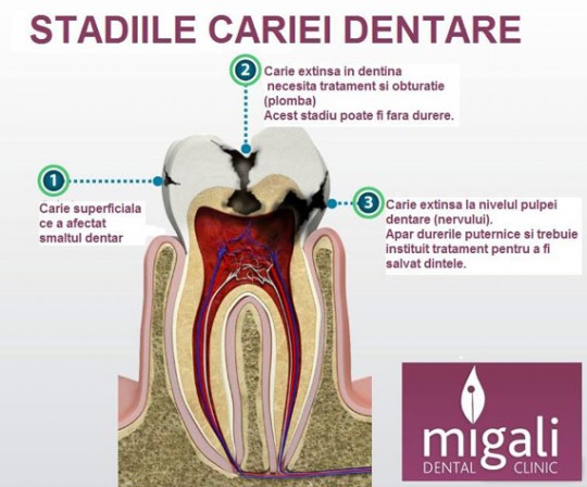 caria-dentara-migali-dental-clinic