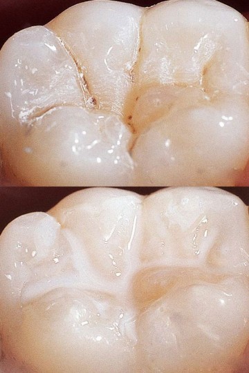 Sigiliare-dentara-Clinica-Stomatologica-Migali-compressor