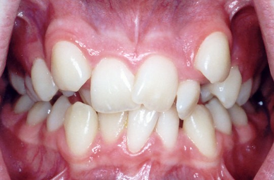 Poza 1 pierderea dintilor - Migali Dental Clinic