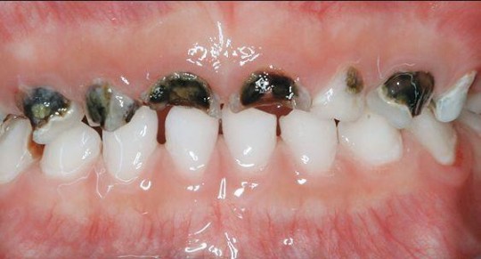 cariile rampante - Migali Dental Clinic