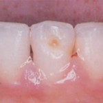 poza 2 traumatisme - dinti de lapte Migali Dental Clinic