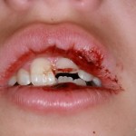 traumatisme - dinti de lapte Migali Dental Clinic